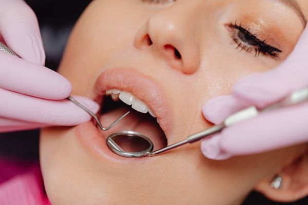 Blanqueamiento Dental Lo Que Debes Saber