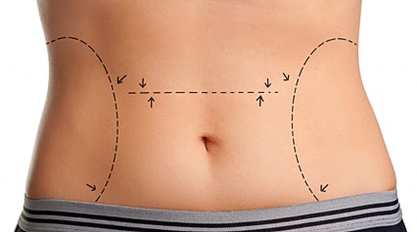 Lipoescultura