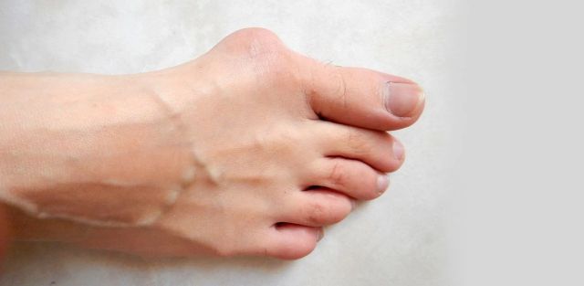 Tratamientos Para Los Juanetes: Todo Lo Que Necesitas Saber